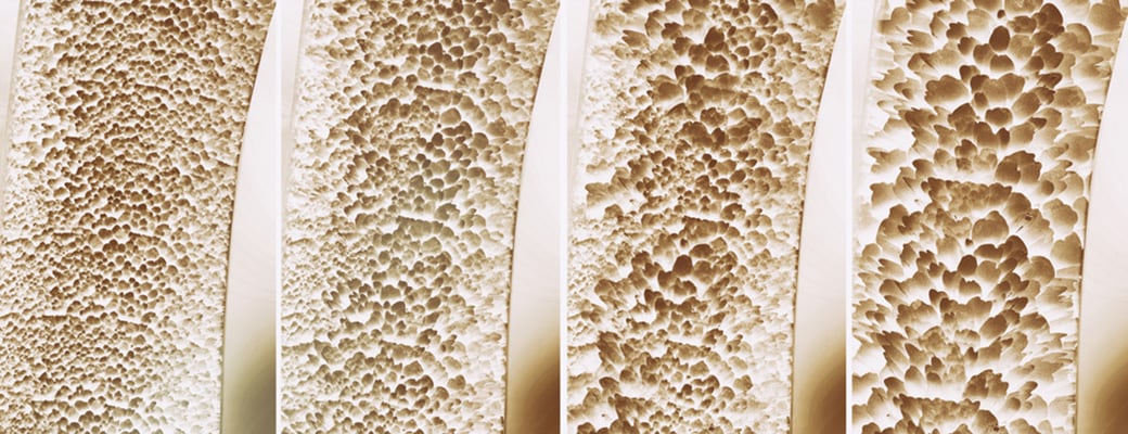 Thema Osteoporose